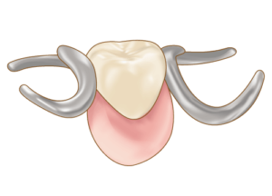 部分入れ歯