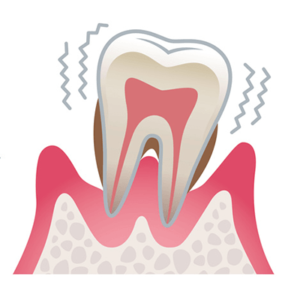 歯周病重度